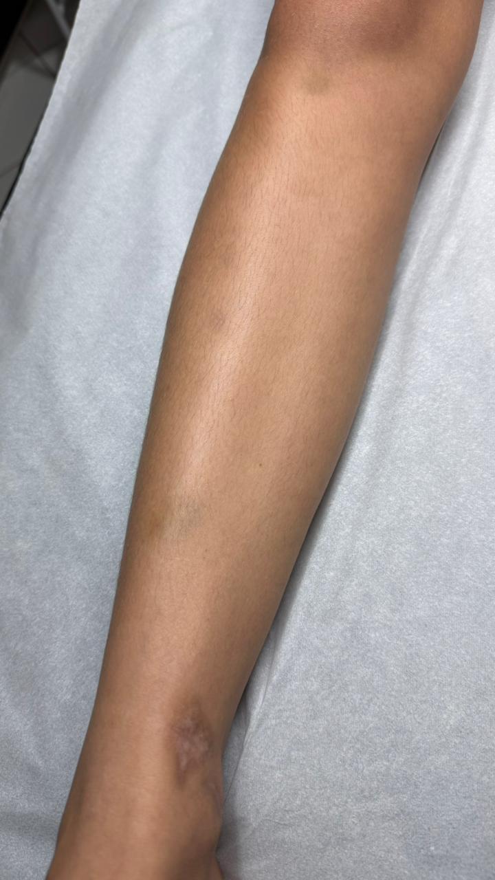 Antes do procedimento de depilação corporal com cera