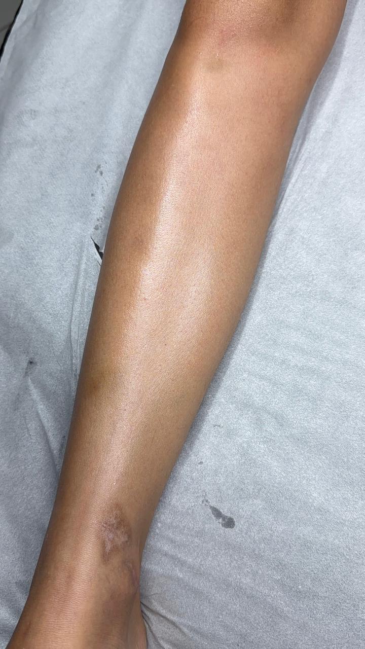 Depois do procedimento de depilação corporal com cera
